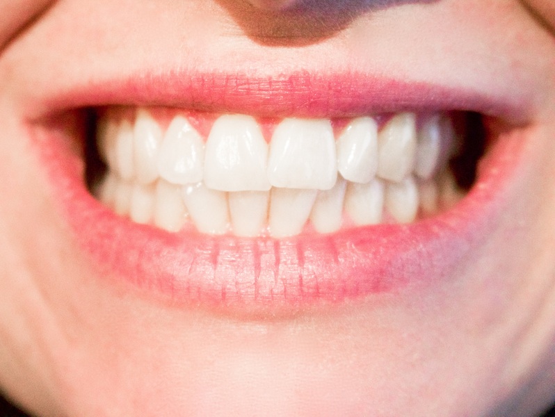 Can Professional Whitening Reverse All Types of Discolouration ?