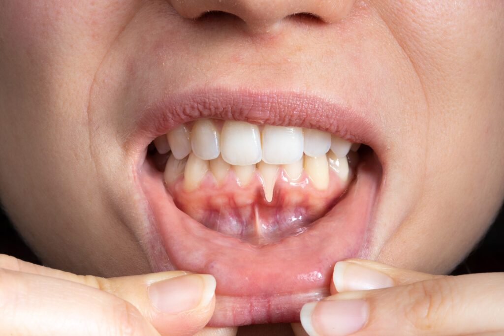 Preparing for teeth whitening with receding gums 